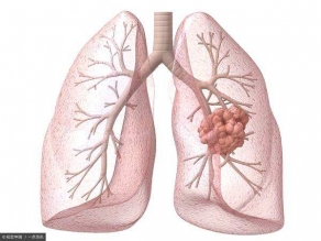 肺癌相关文章二